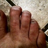 black toenail